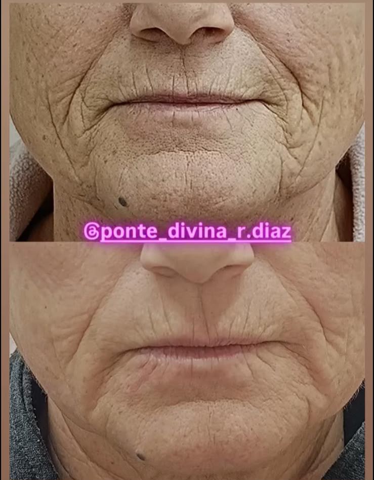 Reducción de arrugas del rostro con Fibroblast