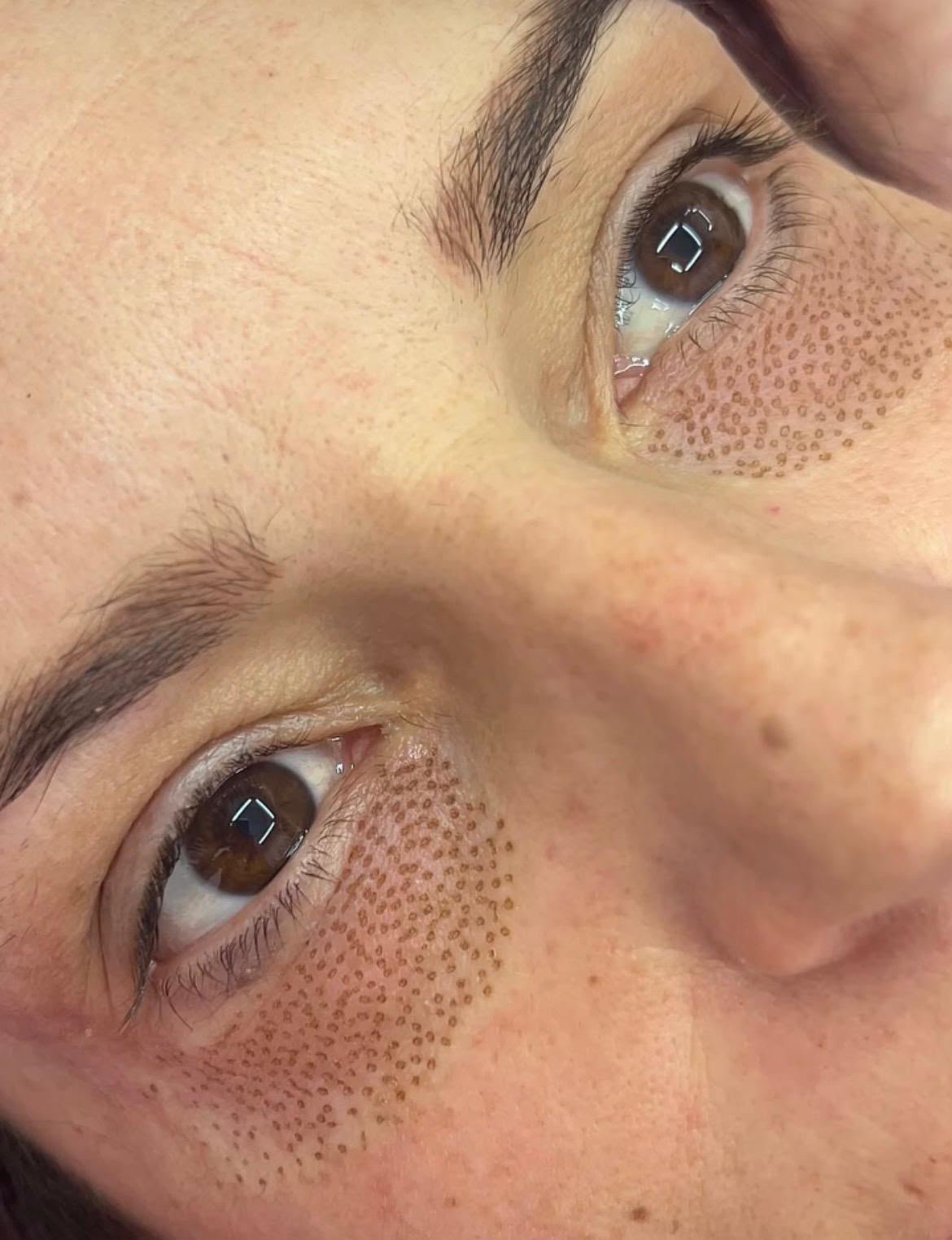 Plasma Pen en la zona de ojeras con los puntitos