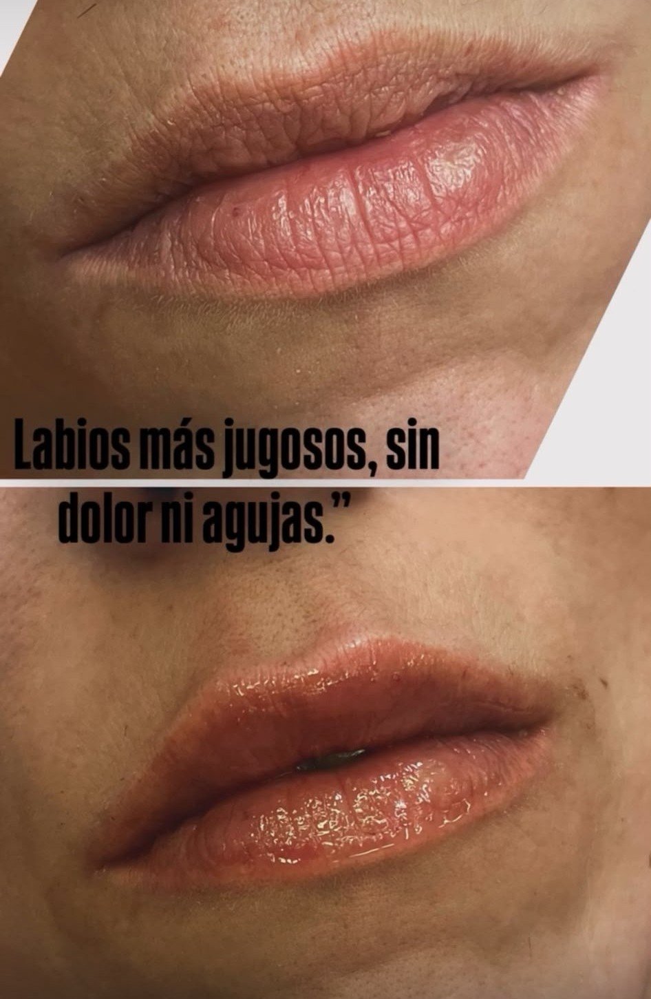 Labios más jugosos sin dolor ni agujas con Hyaluron Pen