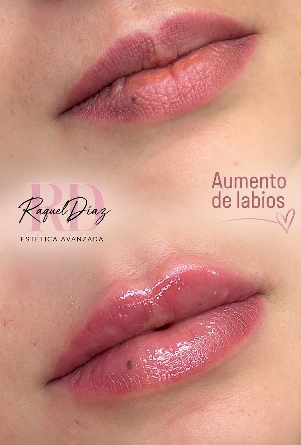 Aumento de labios
