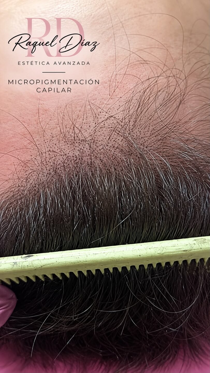 Micropigmentación capilar