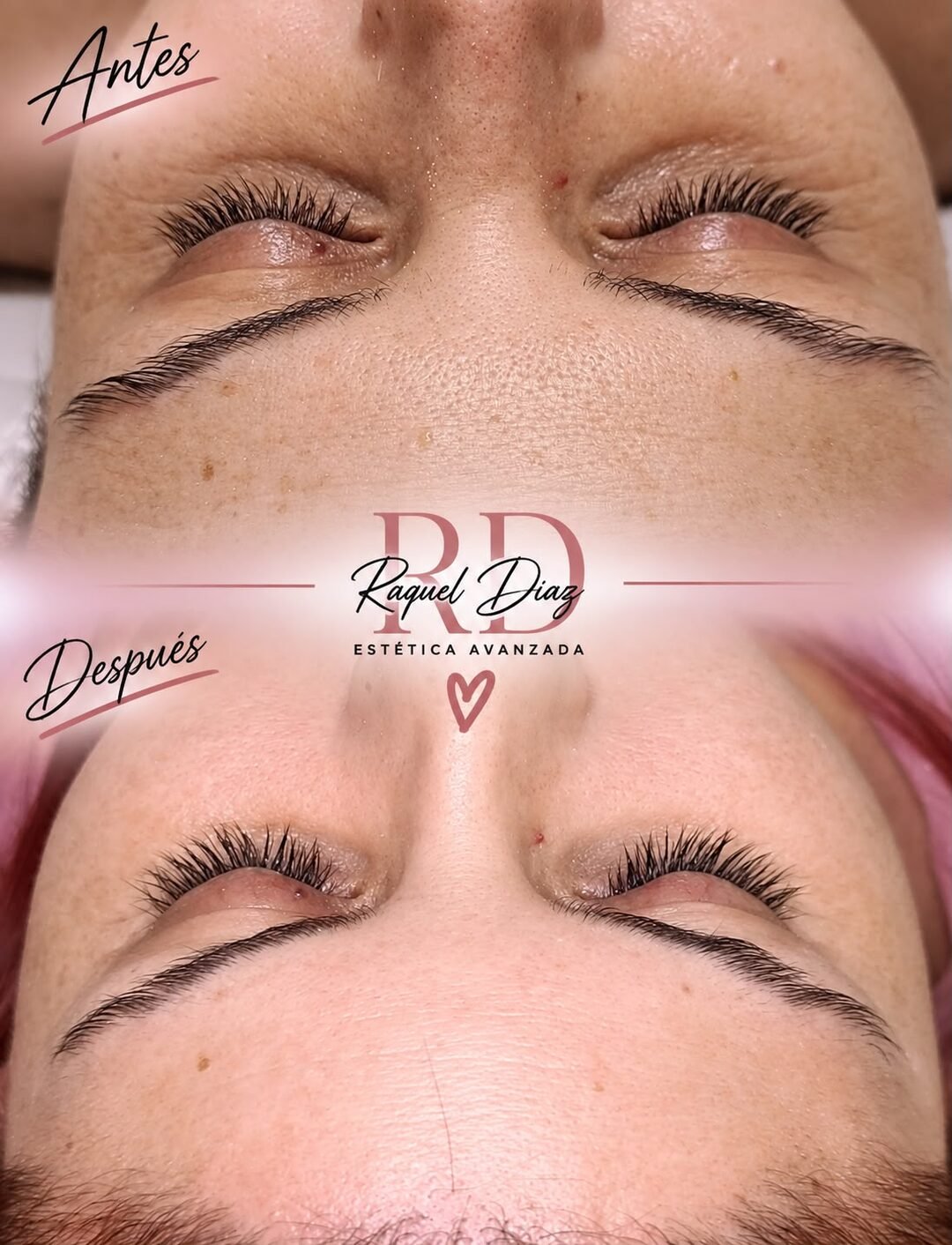 Microneedling (Dermapen)