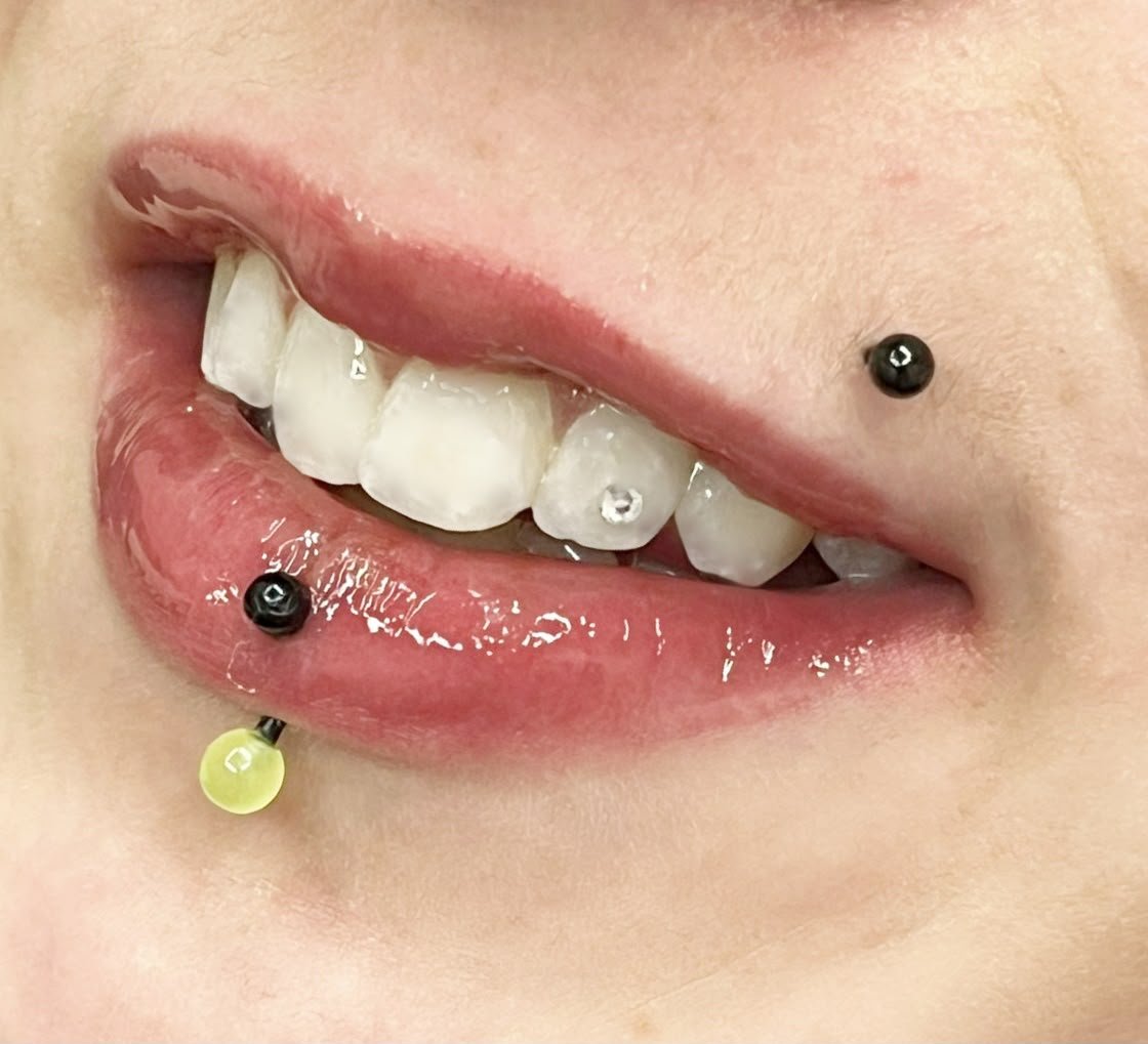 Tooth gem resultado en la sonrisa